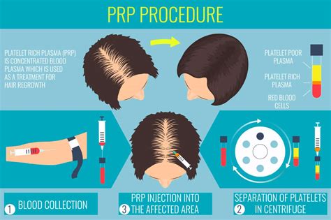 Alles Over PRP Therapie Voor Haarherstel: Wat Zijn De Voordelen?