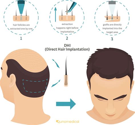 DHI Vs FUE: Welke Methode Voor Haartransplantatie Is Het Beste?