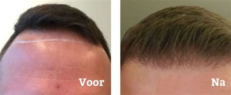 Haartransplantatie: Keuzes Voor Haarlijn Vormgeving