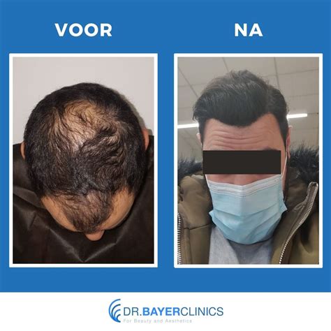 Haartransplantatie Voor En Na: Trends En Innovaties