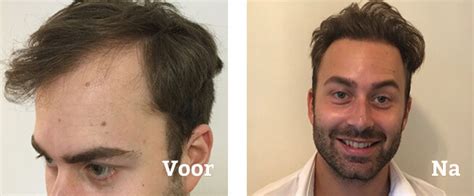 Haartransplantatie: Wat Te Verwachten Tijdens De Behandeling