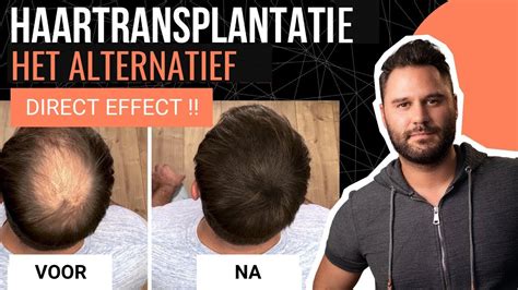 Kosten Haartransplantatie: Wat Kun Je Echt Verwachten?