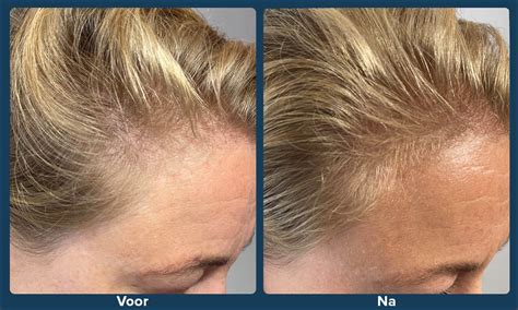 XL Hair: Geschiktheid Voor Verschillende Haartypes