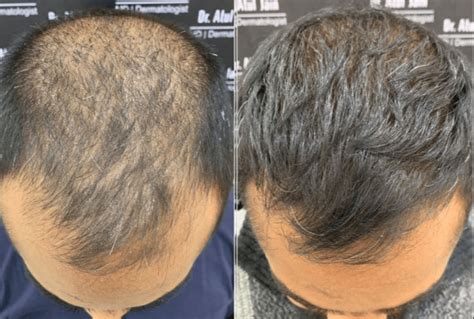 De Verschillen Tussen Haartransplantatie En PRP