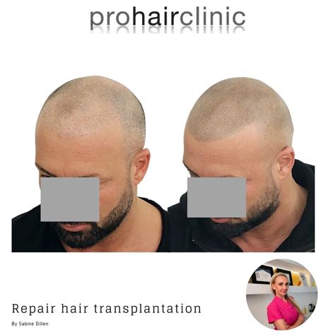 Haartransplantatie En Microhaar Pigmentatie: Wat Is Het Verschil?