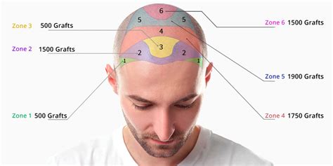 Haartransplantatie Kosten: Wat Is De Waarheid?