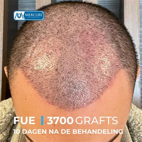 Haartransplantatie Saffier FUE: Waarom Kiezen?