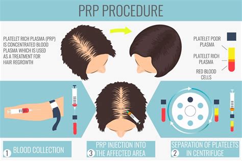 PRP: De Nieuwste Innovaties In Haarbehandeling