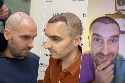 Realistische Verwachtingen Bij Haartransplantatie