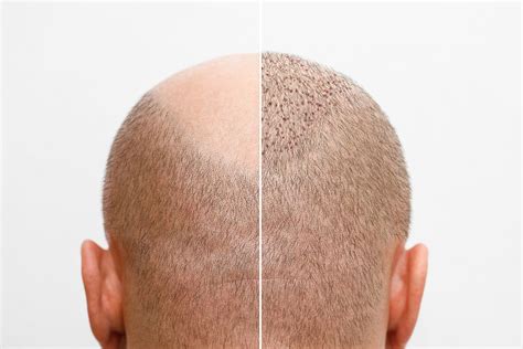 Haartransplantatie Nazorg: Tips Voor Het Beste Resultaat