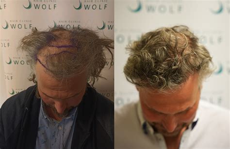 Best Geteste Haartransplantatie Klinieken In Nederland