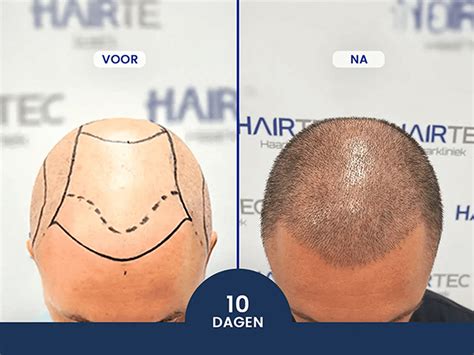 De Gemiddelde Duur Van Een Haartransplantatie