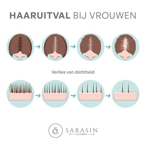De Invloed Van Hormonen Op Haaruitval Bij Vrouwen