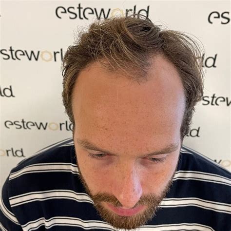 Mijn Haartransplantatie Ervaring: Een Persoonlijk Verhaal